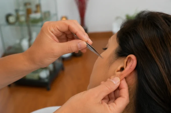 Acupuntura en Puebla Opciones sin Agujas